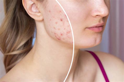 10 Vitamins And Minerals That Help Clear Up Acne