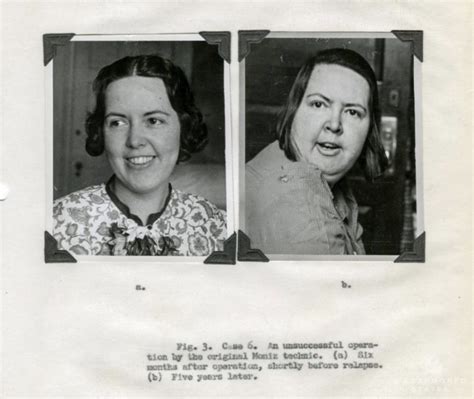 15 Lobotomy Patients Before And After Their Procedure