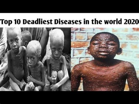 20 Deadliest Diseases In The World Youtube