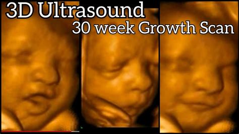 3D Ultrasound 30 Weeks Baby Growth Scan Nt Scan 30 Week Baby