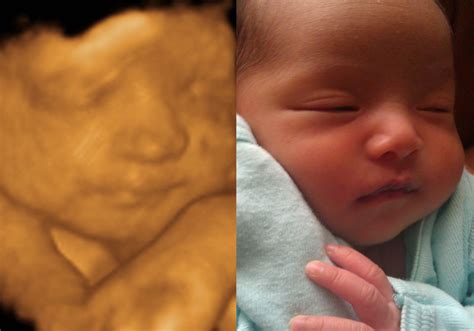 3D Ultrasound Baby 3D 4D Hd Ultrasound Virginia