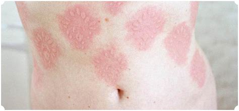 5 Rare Skin Disorders The Skiny