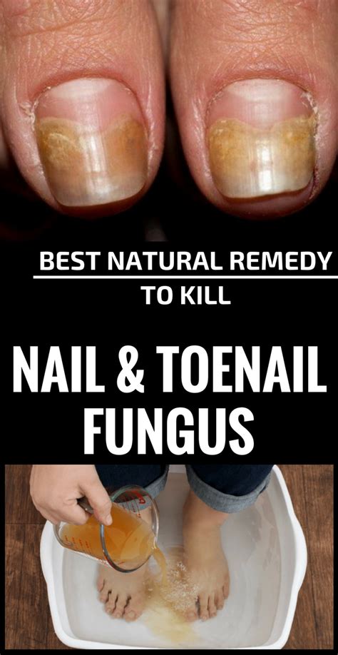 9 Best Natural Home Remedies For Toenail Fungus Toenail Fungus