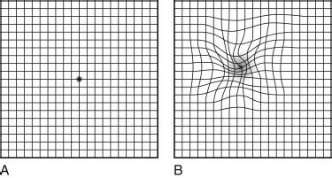 Amsler Grid Test Interpretation