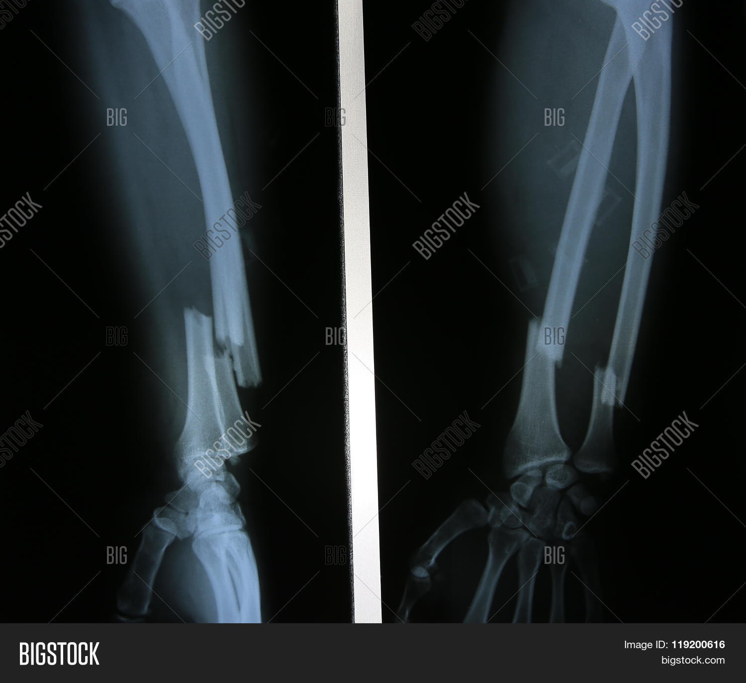 5 Ways X-Rays Show Amplitude