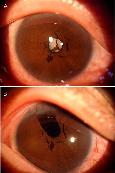 Bilateral Persistent Pupillary Membranes Associated With Cataract