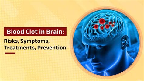 Blood Clot In Brain Causes Symptoms Treatment And Lot More