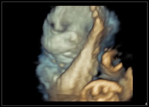 Capture The Unforgettable With Our 4D Ultrasound