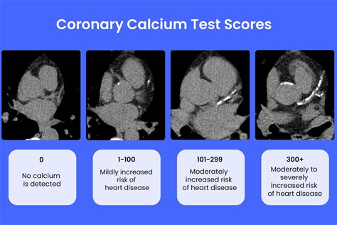 Coronary Calcium Test What Is It Procedure And Results