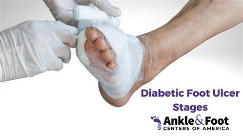 Diabetic Foot Ulcers Surgery Options To Treat And Prevent Podiatric