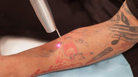 Discover The Latest Tattoo Removal Techniques