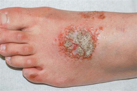 Eczema Blisters Symptoms Location And Treatment