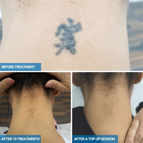 Find Out How Long It Takes To Get That Tattoo Removed Get Ready For A