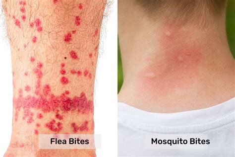 Flea Bites Vs Mosquito Bites