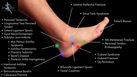 7 Common Causes of Foot Pain