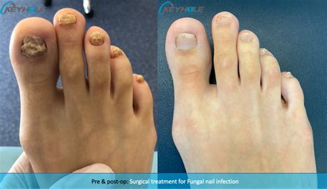 Fungal Nail Laser Treatment Perth Perth Podiatric Surgery