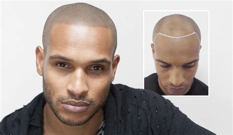 Hair Tattoo Smp Scalp Hairline For Men