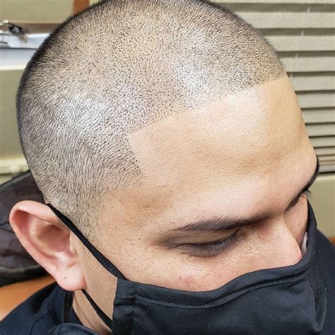 Get a Hair Tattoo to Thicken Your Hairline