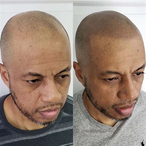 Hairline Tattoo Cosmetic Tattoo For A Receding Hairline Artofit