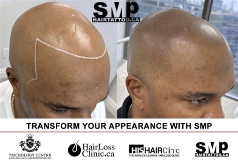 Hairline Tattoo Enhance Your Hairline With Scalp Micropigmentation