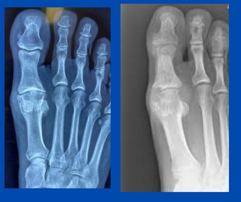 Treating Hallux Limitus Rigidus for Optimal Foot Health