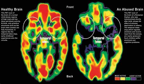 Head Centered Neglect: Understanding the Invisible Disability