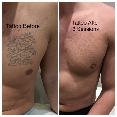 How Much Does Tattoo Removal Cost Zerkalovulcan