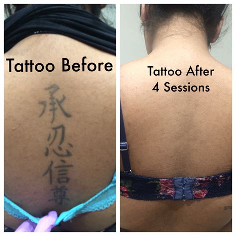 How Much Does Tattoo Removal Cost