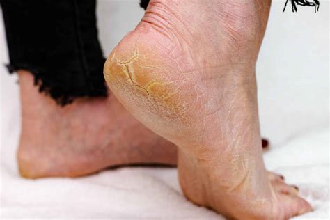 How To Get Rid Of Dead Dry Skin On Feet