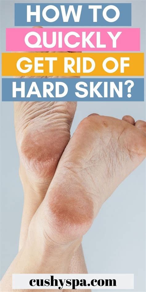 How To Get Rid Of Dead Skin On Feet Step By Step Guide Artofit