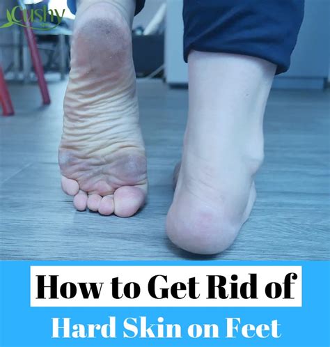 How To Remove Dead Skin From The Feet My Footdr