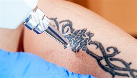 How To Remove Unwanted Laser Tattoo Permanently And Safely Tattoo