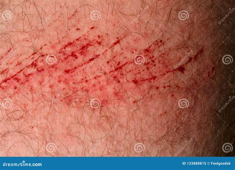 Itchy Skin Scratch Marks Stock Photos Free Royalty Free Stock