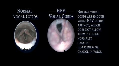 5 Ways Laryngeal Papillomatosis Affects Your Voice