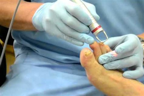 Laser For Fungal Nail Infections The Foot Clinic