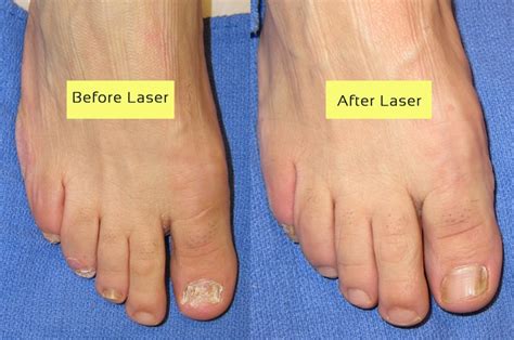 Laser Surgery for Toenail Fungus Relief