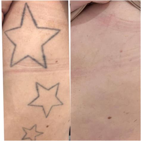 Laser Tattoo Removal Brisbane Injex Clinics