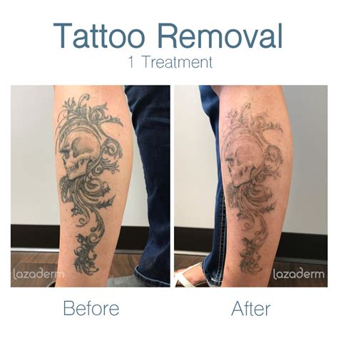 5 Ways to Find Laser Tattoo Removal Near You