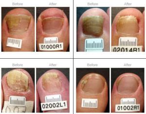 Laser Treatment For Fungal Toenails Associated Foot Ankle Specialists