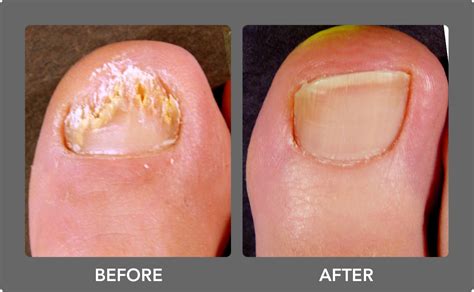 Laser Treatment For Toenail Fungus Before And After Photos