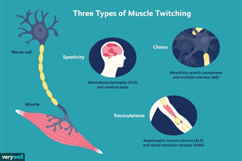 Muscle Twitching Causes Types And Diagnosis