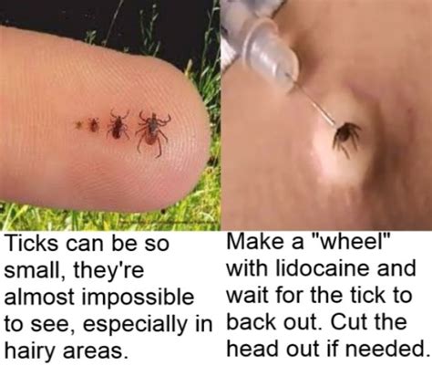 New Tricks For Removing Ticks Avoiding Rmsf Lyme Disease Tick