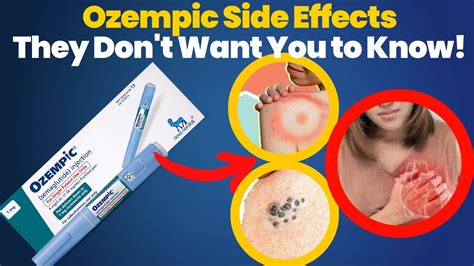 Ozempic Side Effects Causes Prevention And Management They Don T