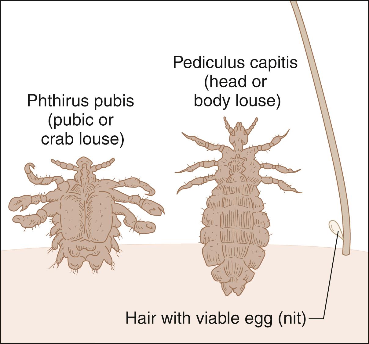 Pediculosis Lice Crabs Anesthesia Key