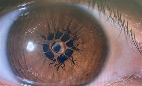 Persistent Pupillary Membrane American Academy Of Ophthalmology