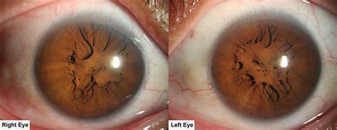 Persistent Pupillary Membranes Ophtalmov T Rinaire