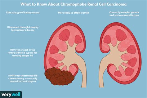 Pin On Kidney Cancer Renal Cell Carcinoma