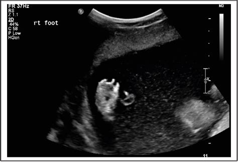 Prenatal Sonographic Detection Of Multiple Congenital Anomalies A Case