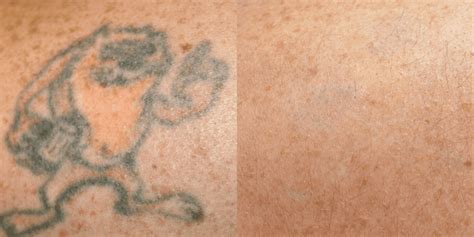 Remove Unwanted Tattoos Safely With Picosure Laser Treatments