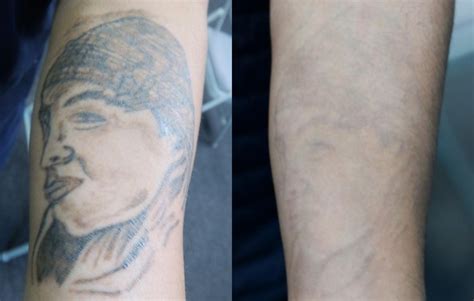 San Pablo Edc Offers Low Cost Tattoo Removal Richmond Standard